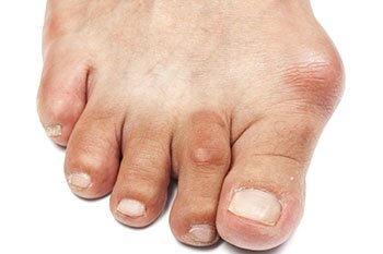 bunions